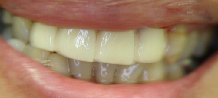 Smile Makeover With Several Crowns 2 After 1