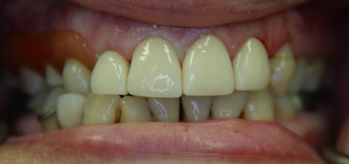 Smile Makeover With Several Crowns 2 After 2