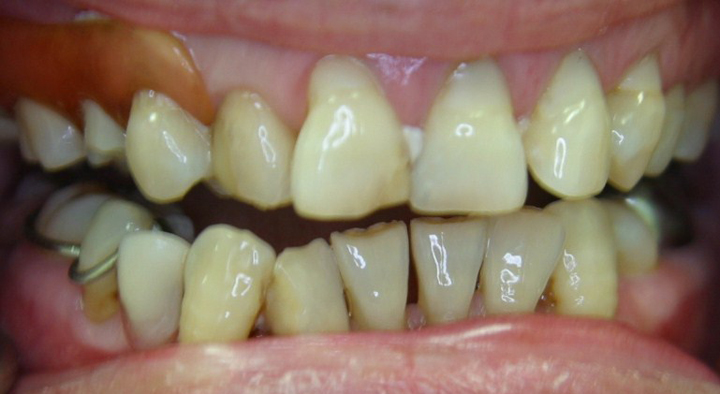 Smile Makeover With Several Crowns 2 Before