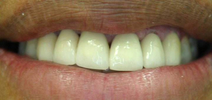 Smile Makeover With Several Crowns 3 After 1