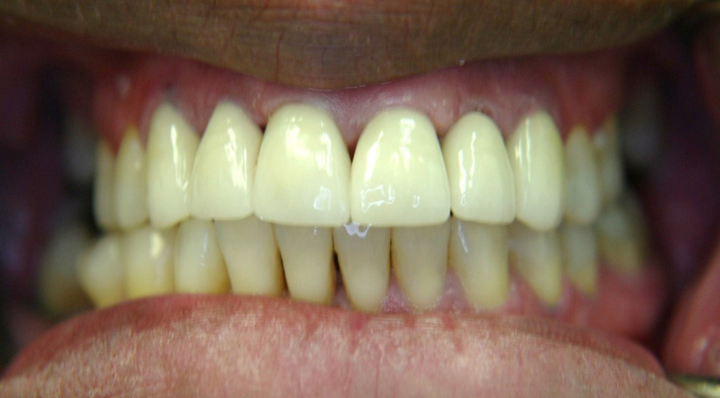 Smile Makeover With Several Crowns 3 After 2