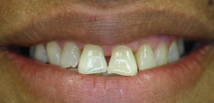 Smile Makeover With Several Crowns 3 Before 1