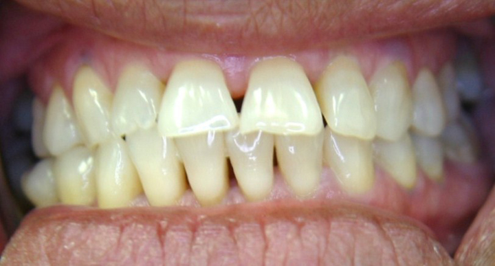 Smile Makeover With Several Crowns 3 Before 2