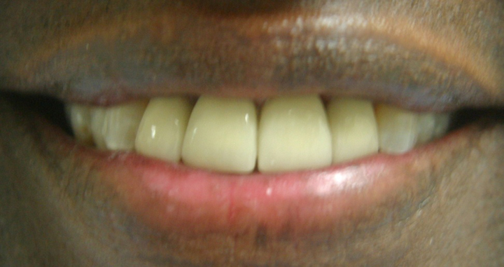 Smile Makeover With Several Crowns 4 After 1