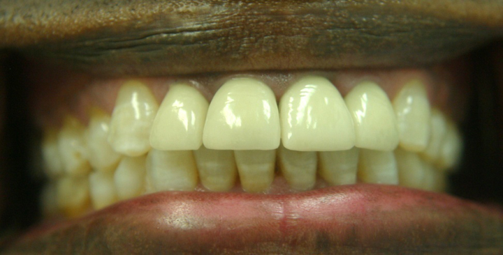 Smile Makeover With Several Crowns 4 After 2