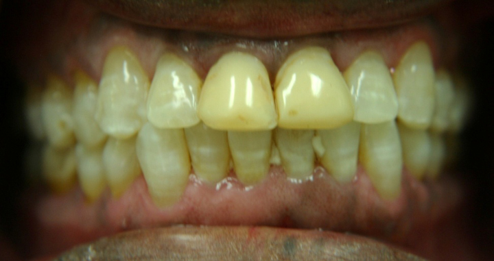 Smile Makeover With Several Crowns 4 Before