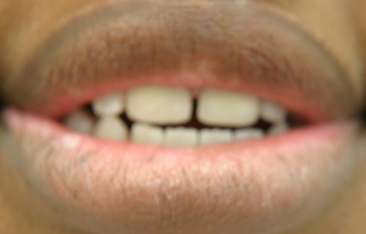 Teeth Alignment With Crowns 1 After