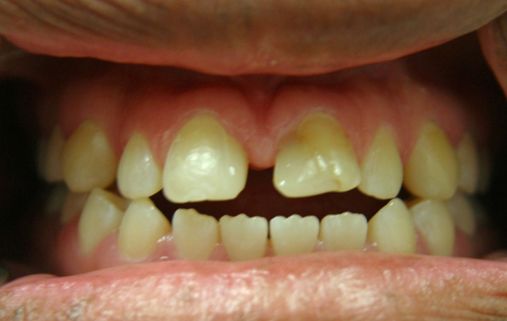 Teeth Alignment With Crowns 1 Before