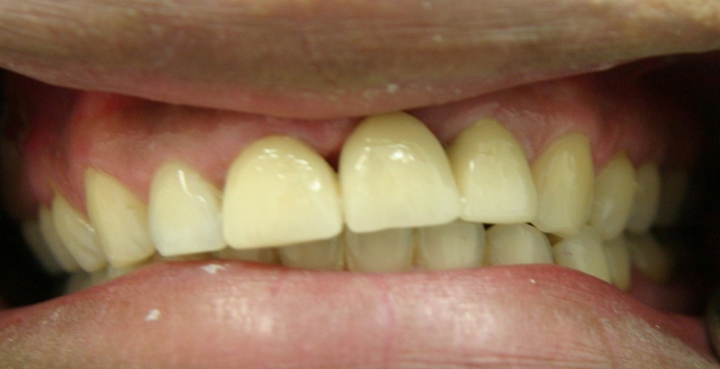 Tooth Replacement With A Bridge 1 After 1