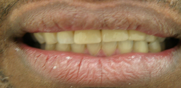 Tooth Replacement With A Bridge 1 After 2