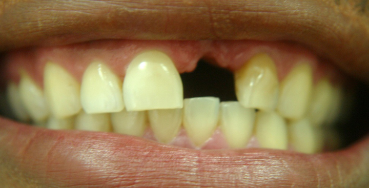 Tooth Replacement With A Bridge 1 Before 1