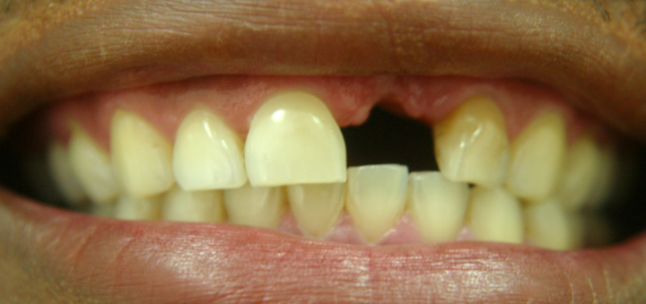 Tooth Replacement With A Bridge 1 Before 2