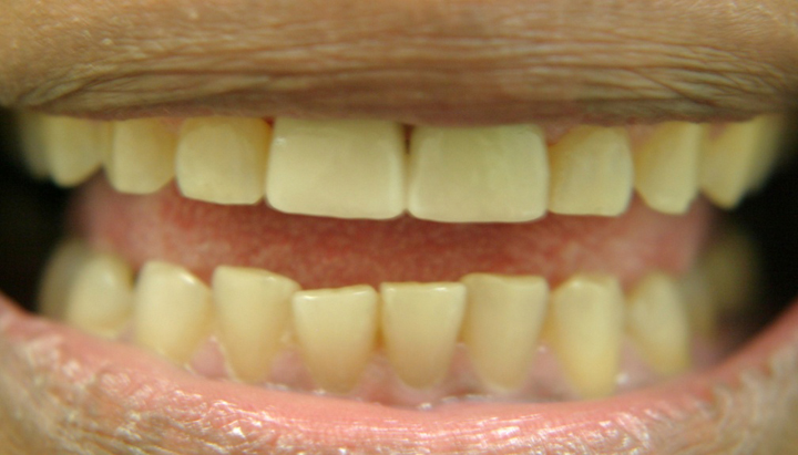 Tooth Replacement With Implant and Crown 1 After 1