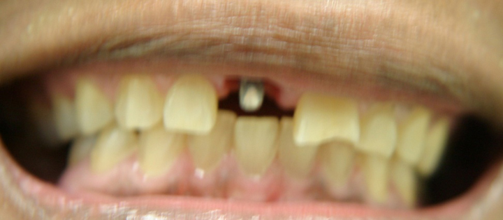 Tooth Replacement With Implant and Crown 1 Before 1
