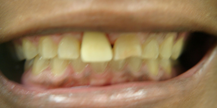 Tooth Replacement With Implant and Crown 1 Before 2